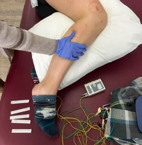 Medical professional examining swollen leg of patient on hospital bed, with electrodes and wires connected for dry needling