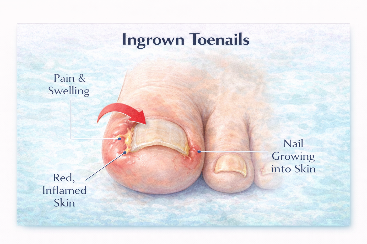Ingrown Toenails: When to See a Professional (and When You Can Wait)