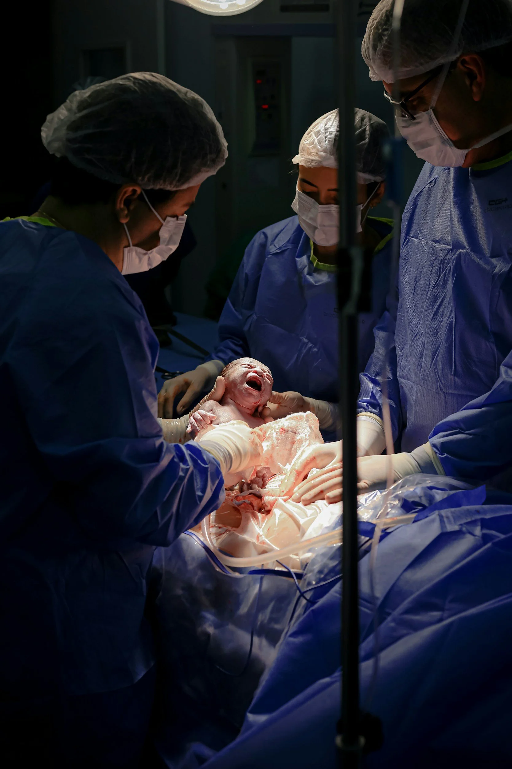 an image of a baby being born via caesarean section