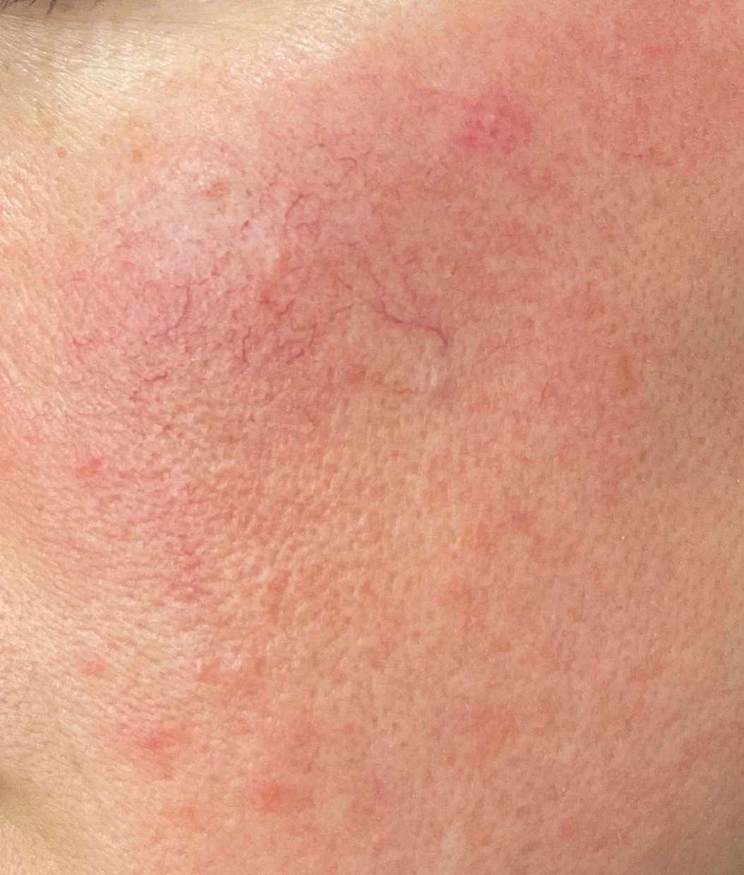 Rosacea