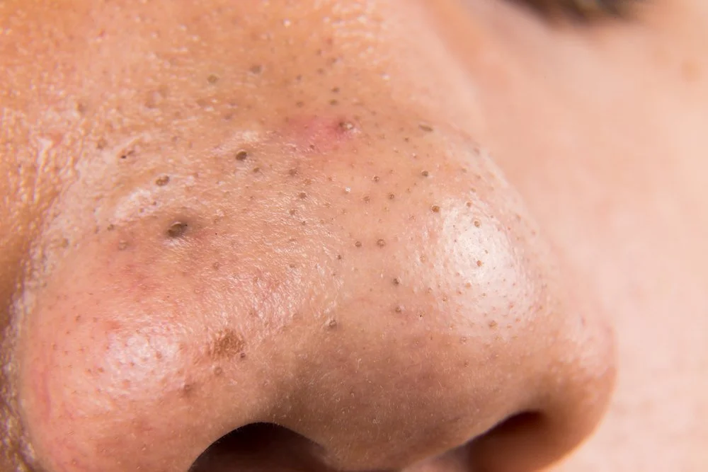 Close-up of a person's nose with visible blackheads and clogged pores.