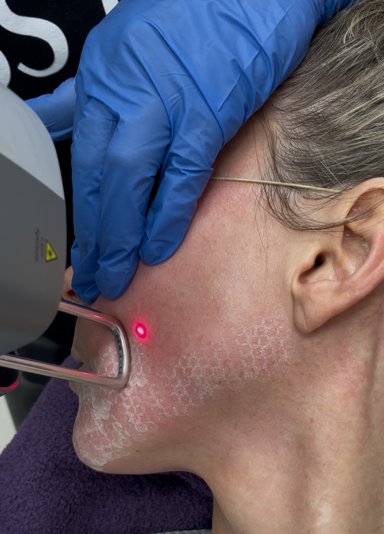 A dermatologist performs a laser treatment on a woman's skin near her jawline, wearing blue gloves and holding a laser device emitting a red light.
