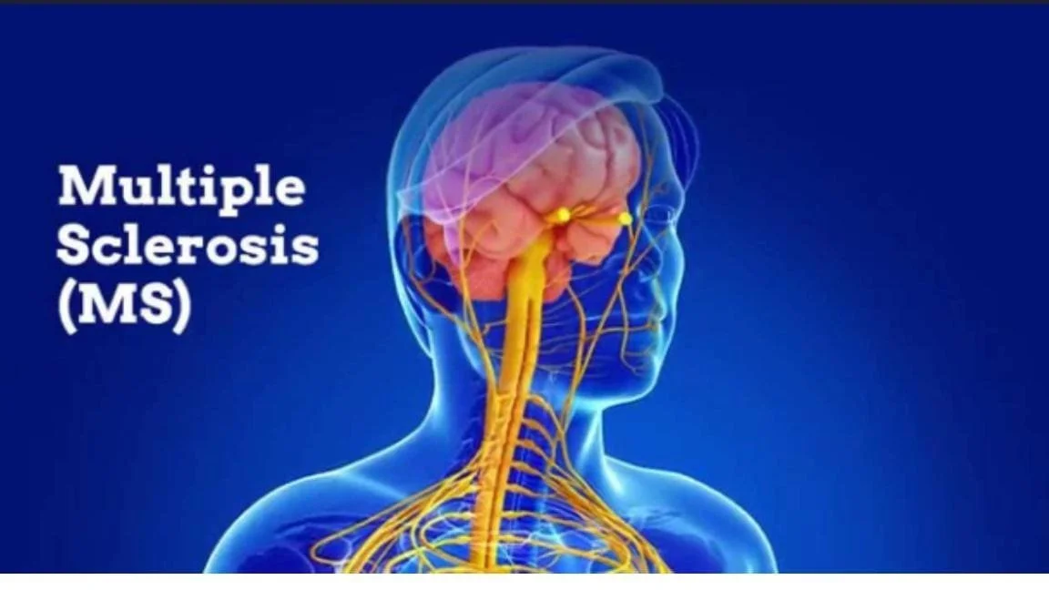 Hyperbaric Oxygen Therapy for Multiple Sclerosis