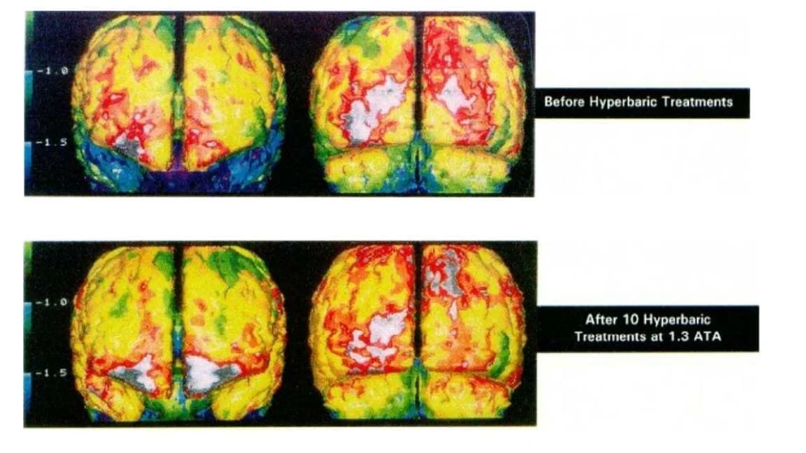 Clinical Study: Mild Hyperbarics for Impaired Brain Function