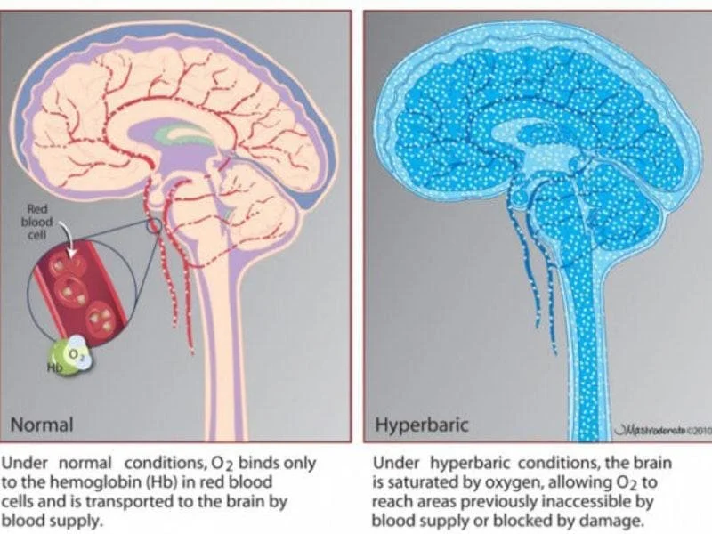 What is Mild Hyperbaric Oxygen Therapy?