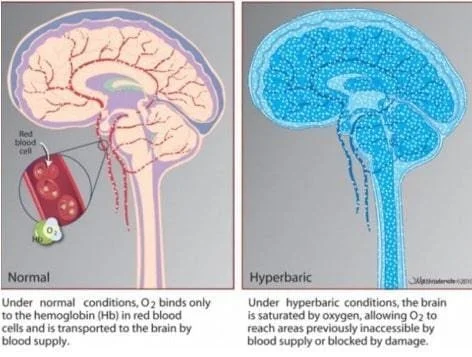 Mild Hyperbaric Oxygen Therapy