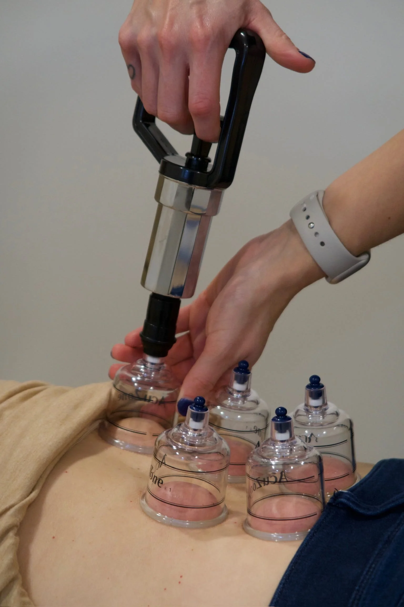 Female chiropractor performing cupping therapy on her patient with low back pain.