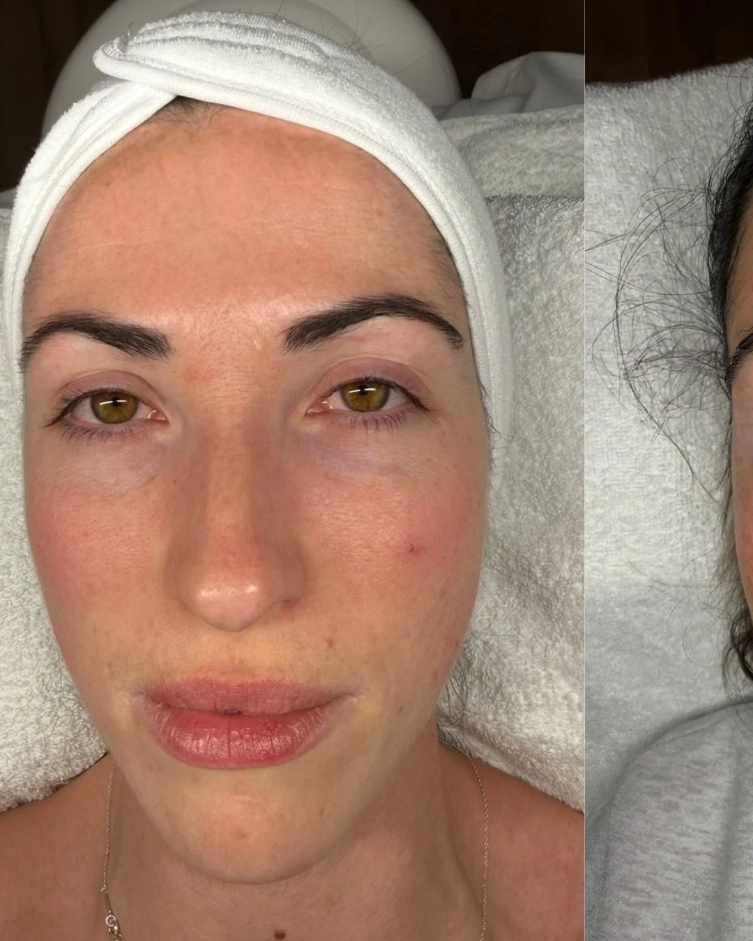 Great skin comes from a plan - not guesswork. 👀💛

My client came to me late last year, preparing her skin for her wedding this July. She felt overwhelmed with skincare and unsure which
treatments to book.

So we stripped it back and focused on:
&bu