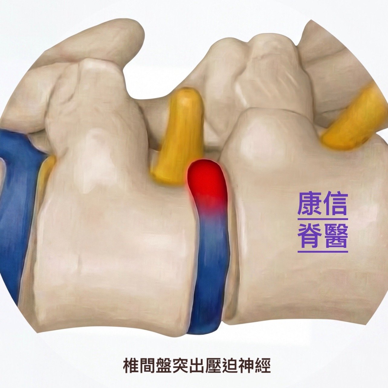 最間盤突出 Disc herniation