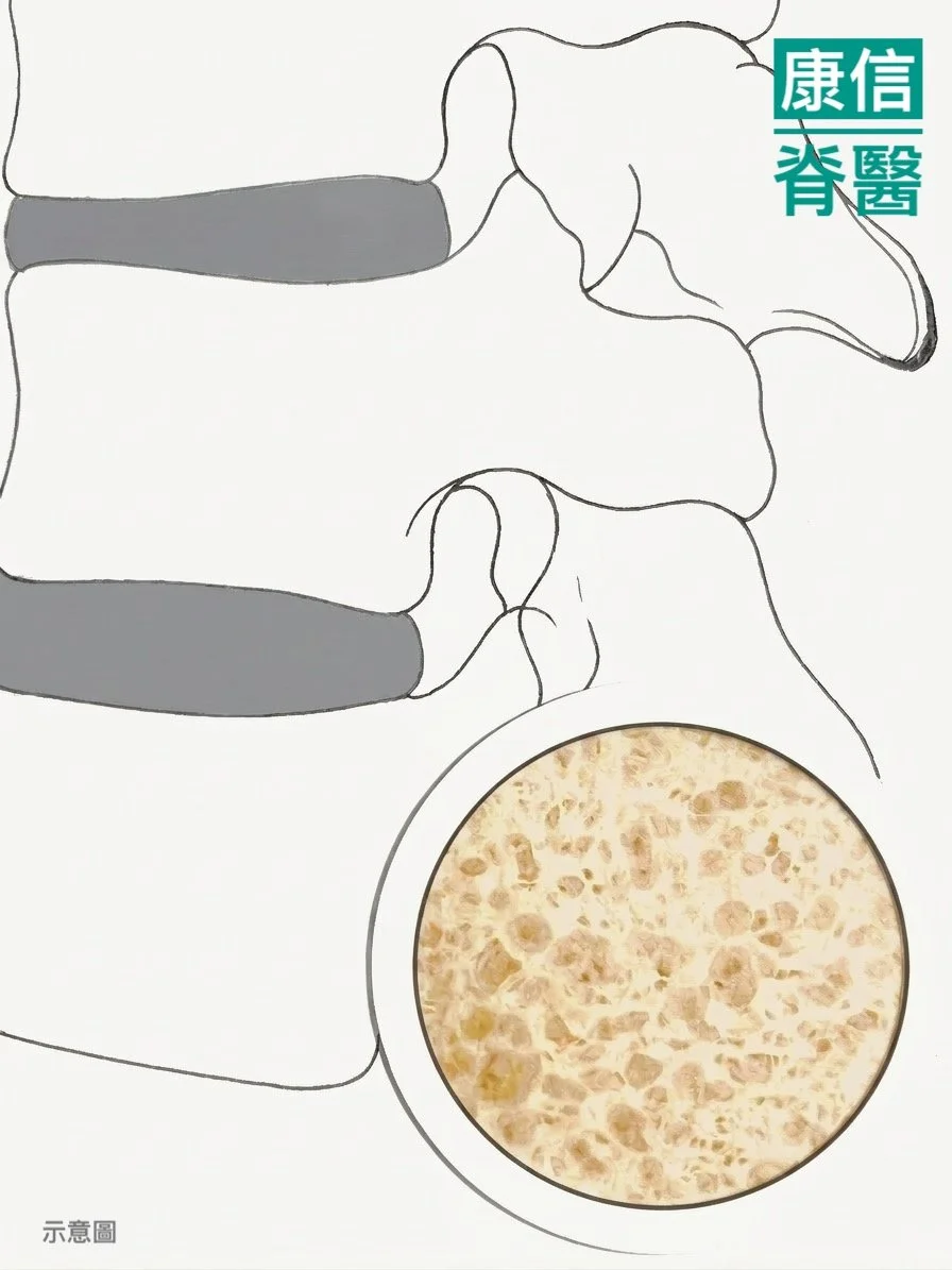 早期骨質疏鬆可無症狀