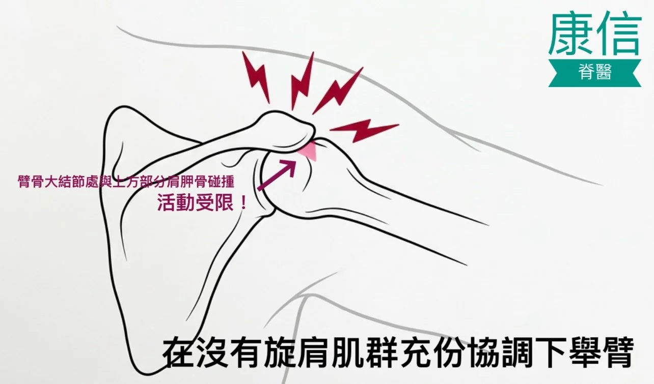shoulder impingement syndrome