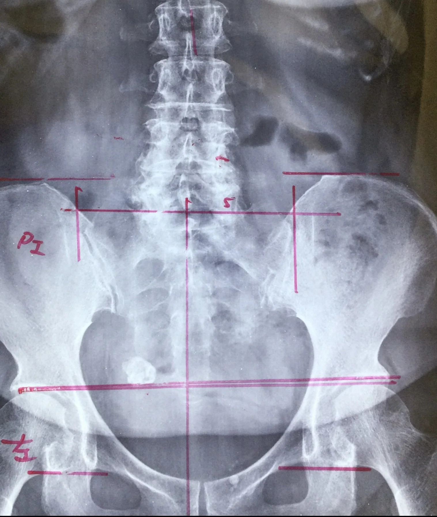 lumbar spine x-ray for chiropractic analysis.
Gonstead method x ray analysis for posture management and chiropractic adjustment