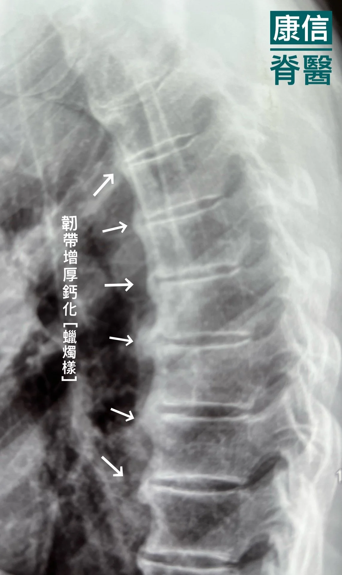 彌漫性突發性骨肥厚