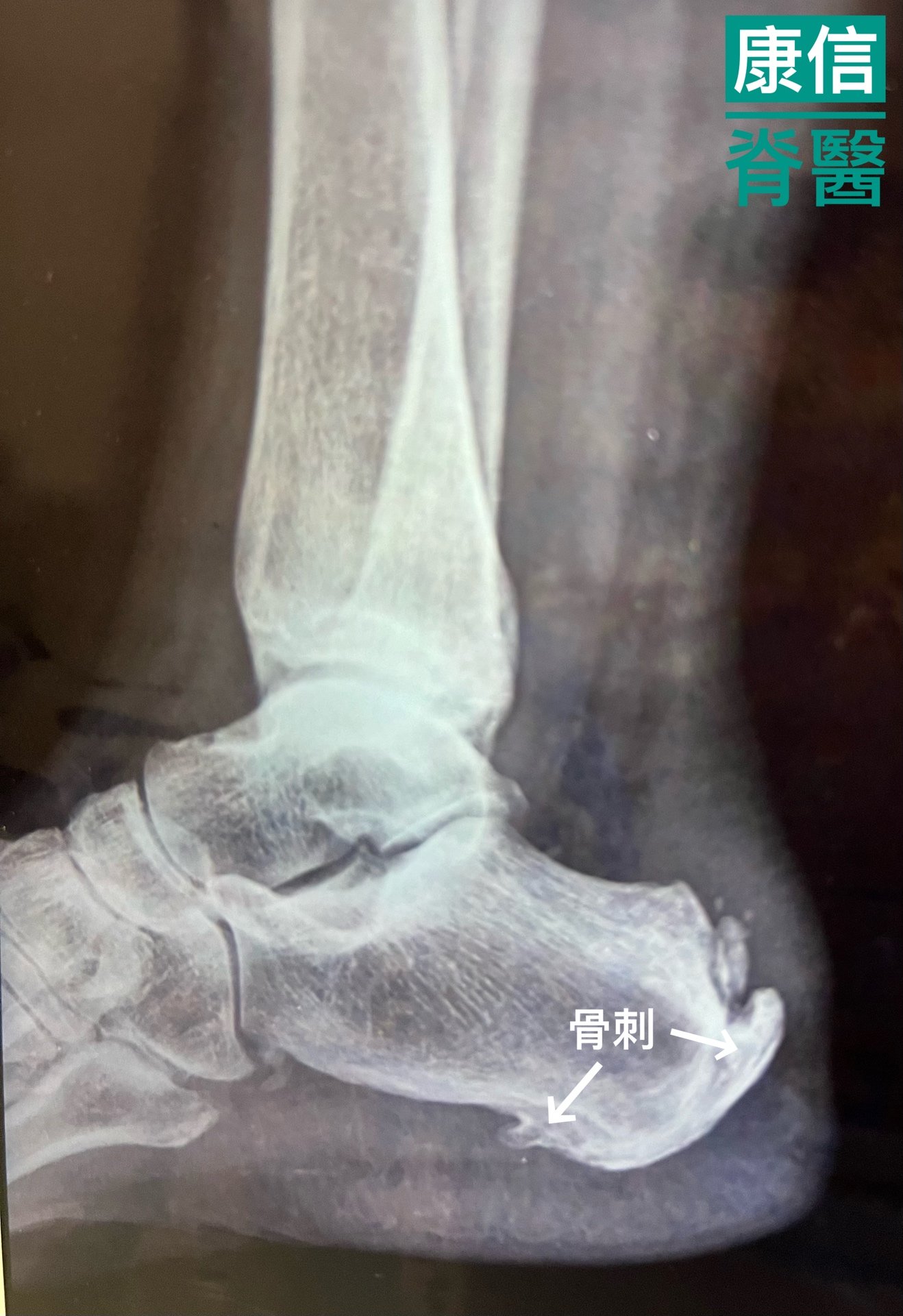 足底筋膜炎