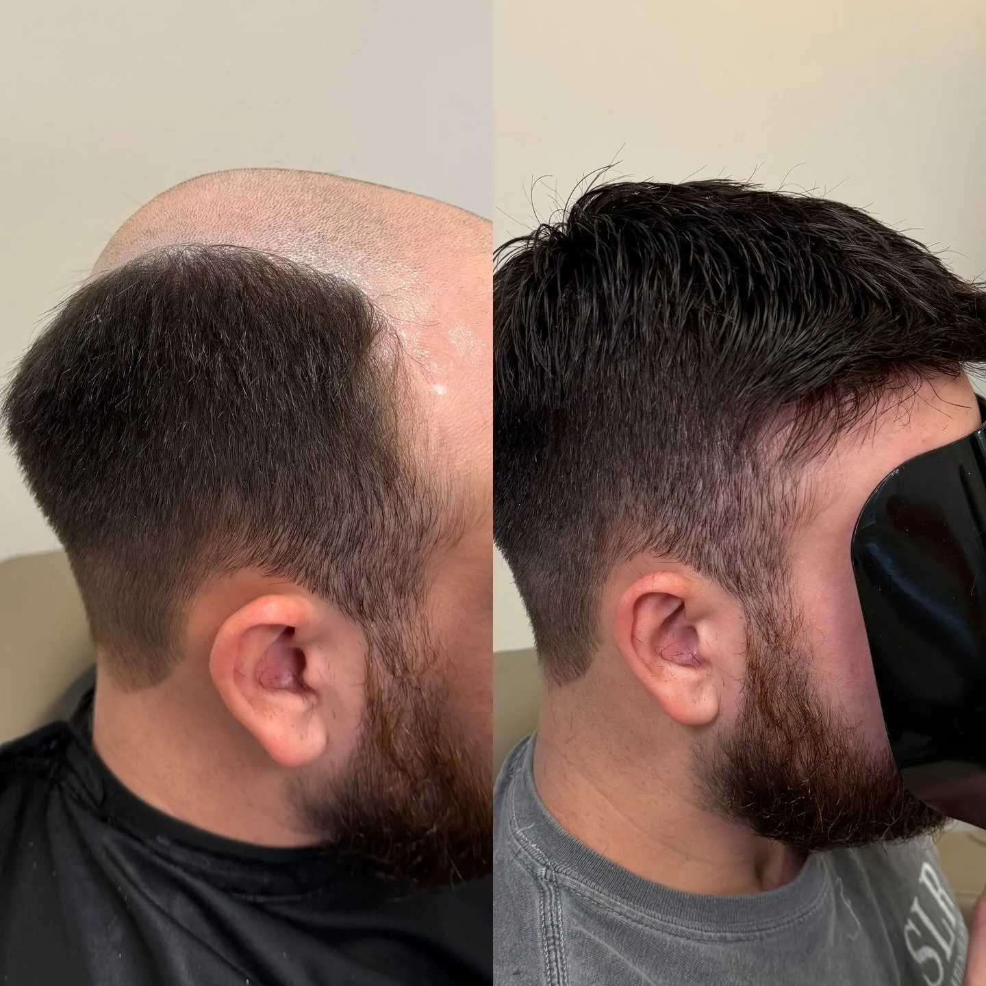 New year new hair systems ✨ #hairloss #hairreplacement