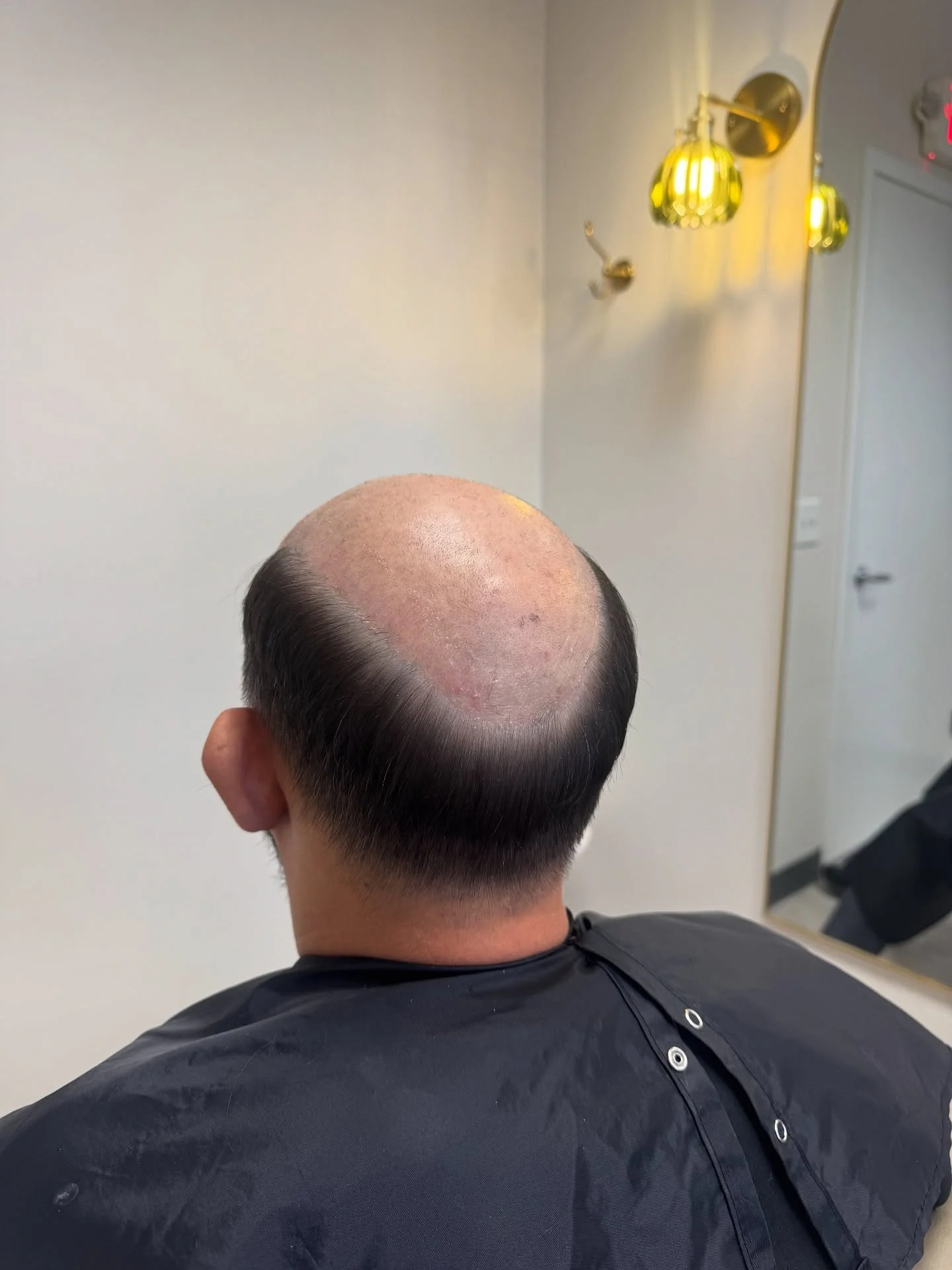 Sometimes we have to go custom hair system- size, color, hair quality, ventilation, base design, and density are all custom variables to this clients needs #hairreplacement #menshairsystem #lacefront