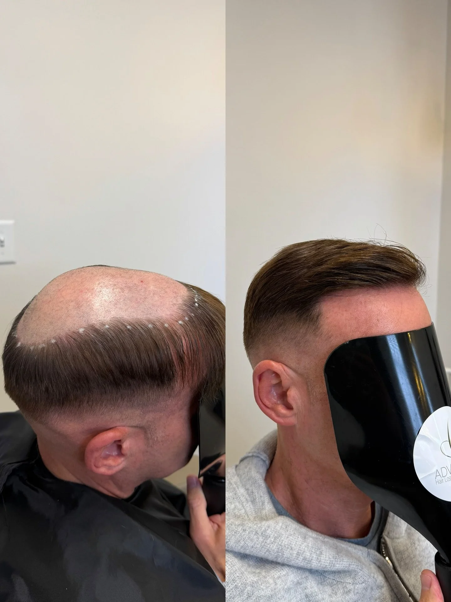 Every system we do is designed specifically for that client &mdash; head shape, density, hairline, and style.

The goal?
Results that look like it&rsquo;s your own hair.

#HairTransformation #HairSystem #MensHairLoss #HairRestoration #AdvancedHairLos