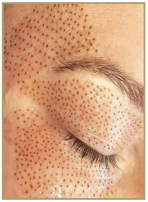 Close-up of a person's closed eye and surrounding skin with numerous small, brown dots.