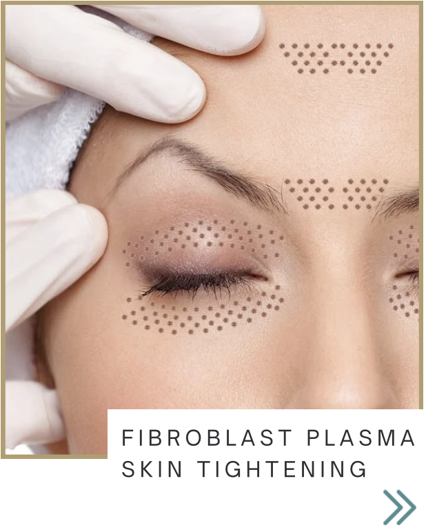 Close-up of a woman receiving fibroblast plasma skin tightening treatment, with dotted markings on her face indicating treatment areas, as a healthcare professional wears gloves and prepares to perform the procedure.