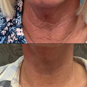 Before & After 1 Session