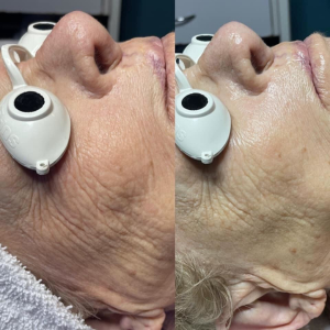 Before & After 5 Session