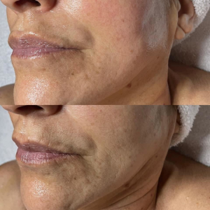 Before & After 5 Session