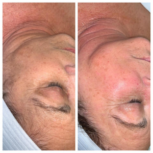 Before & After 1 Session