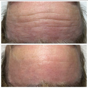 Before & After 1 Session