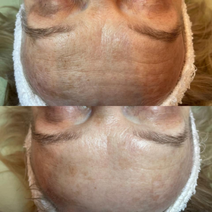 Before & After 1 Session