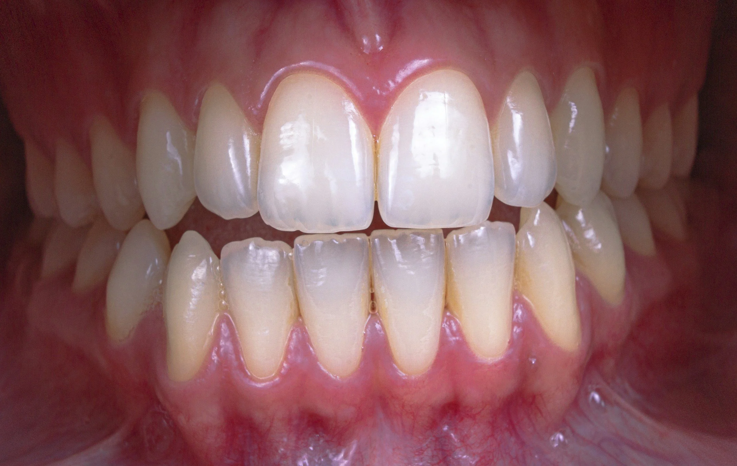 Enamel-Friendly Foods for Your Teeth