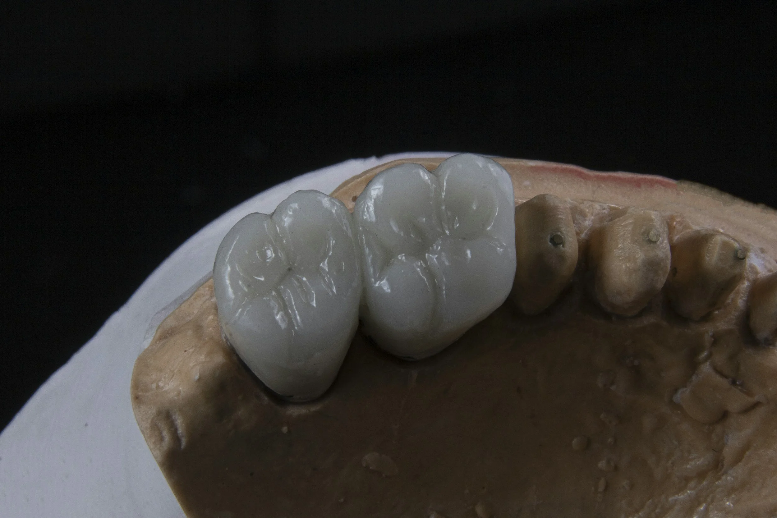 Unique Insight on Dental Bridges