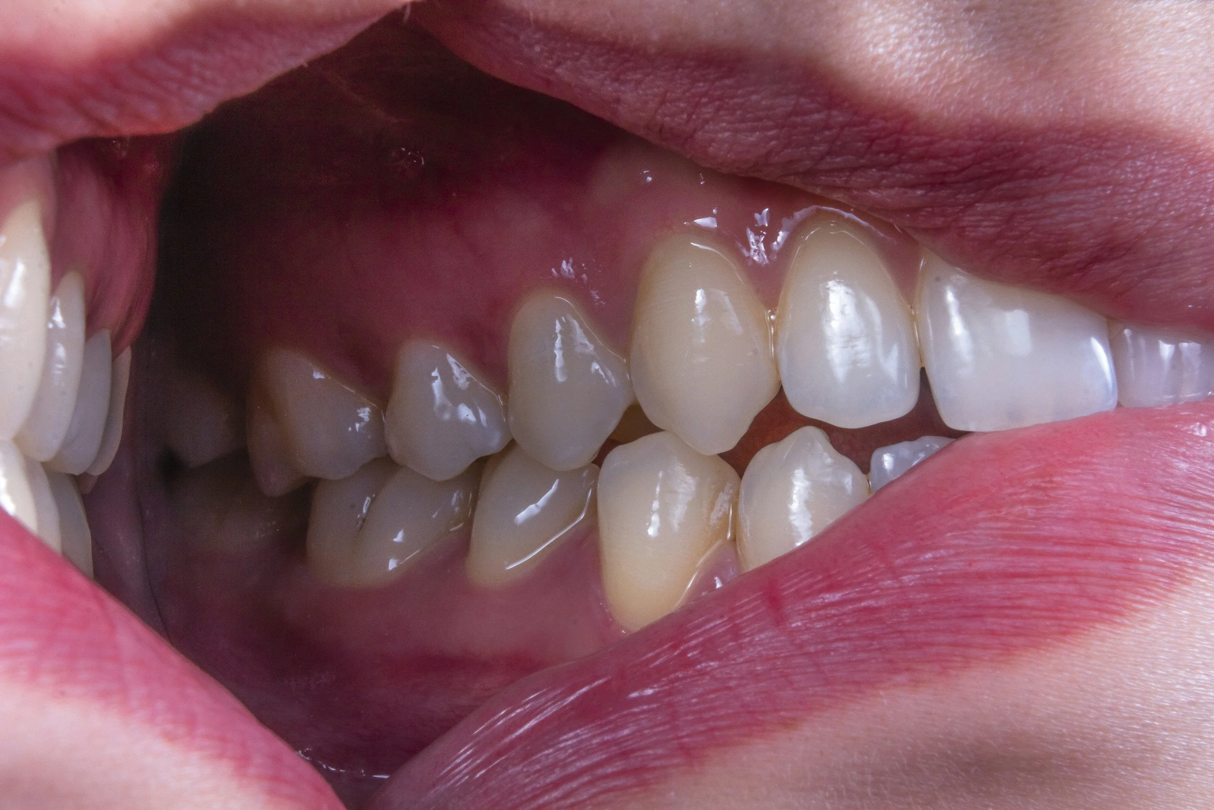 Gum Disease and Periodontitis