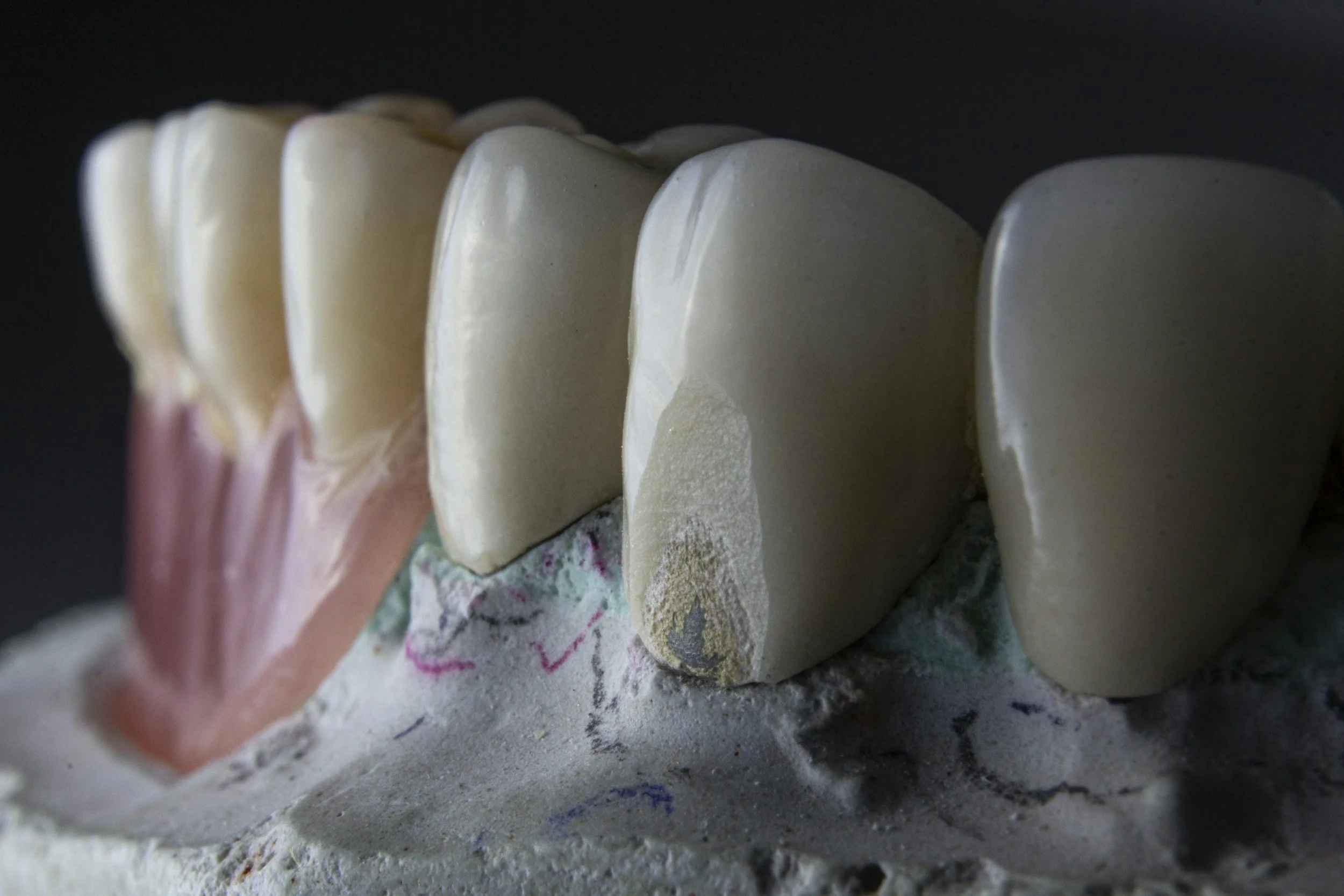 Solutions for Chipped or Broken Teeth