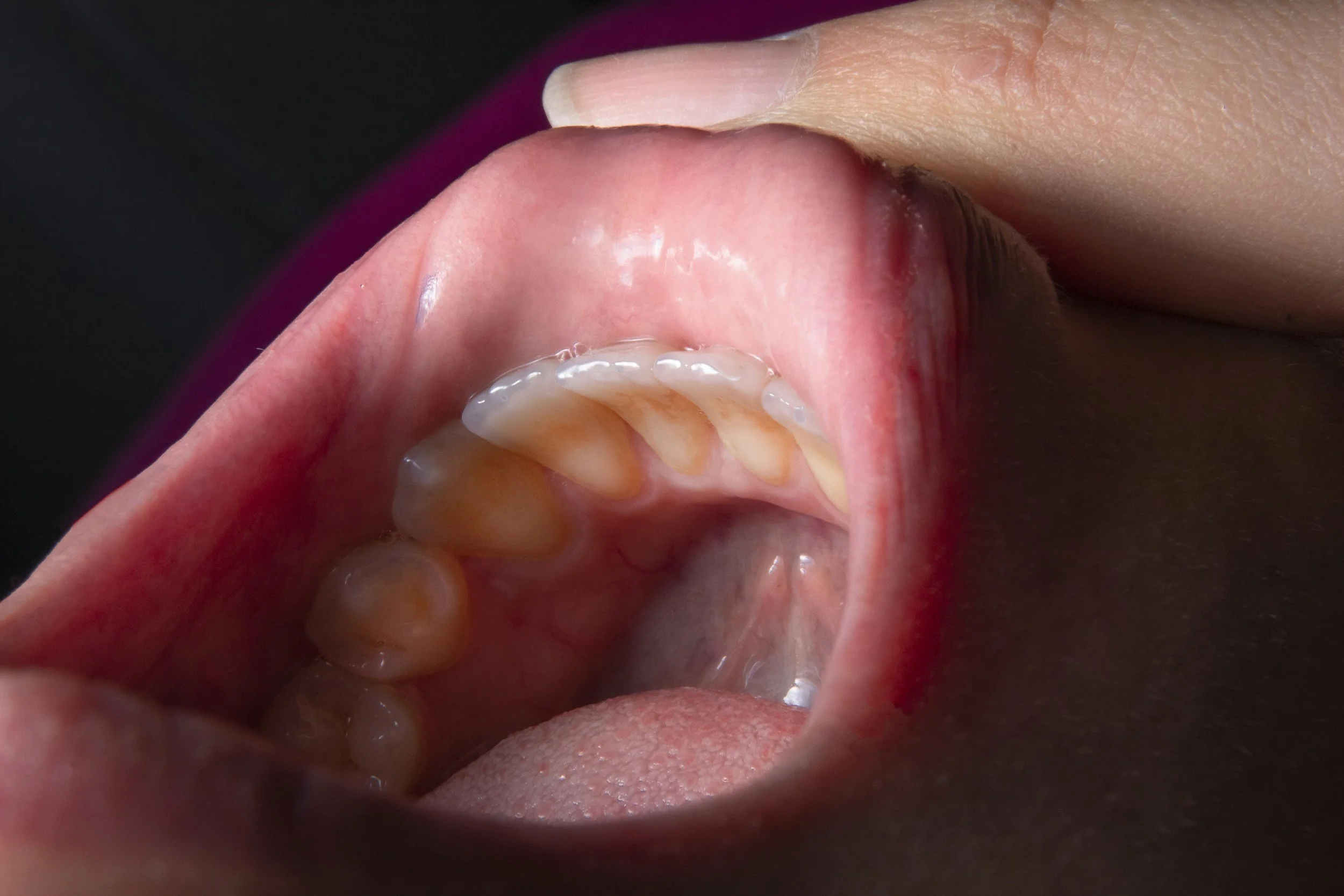 The 7 Warning Signs of Gum Disease