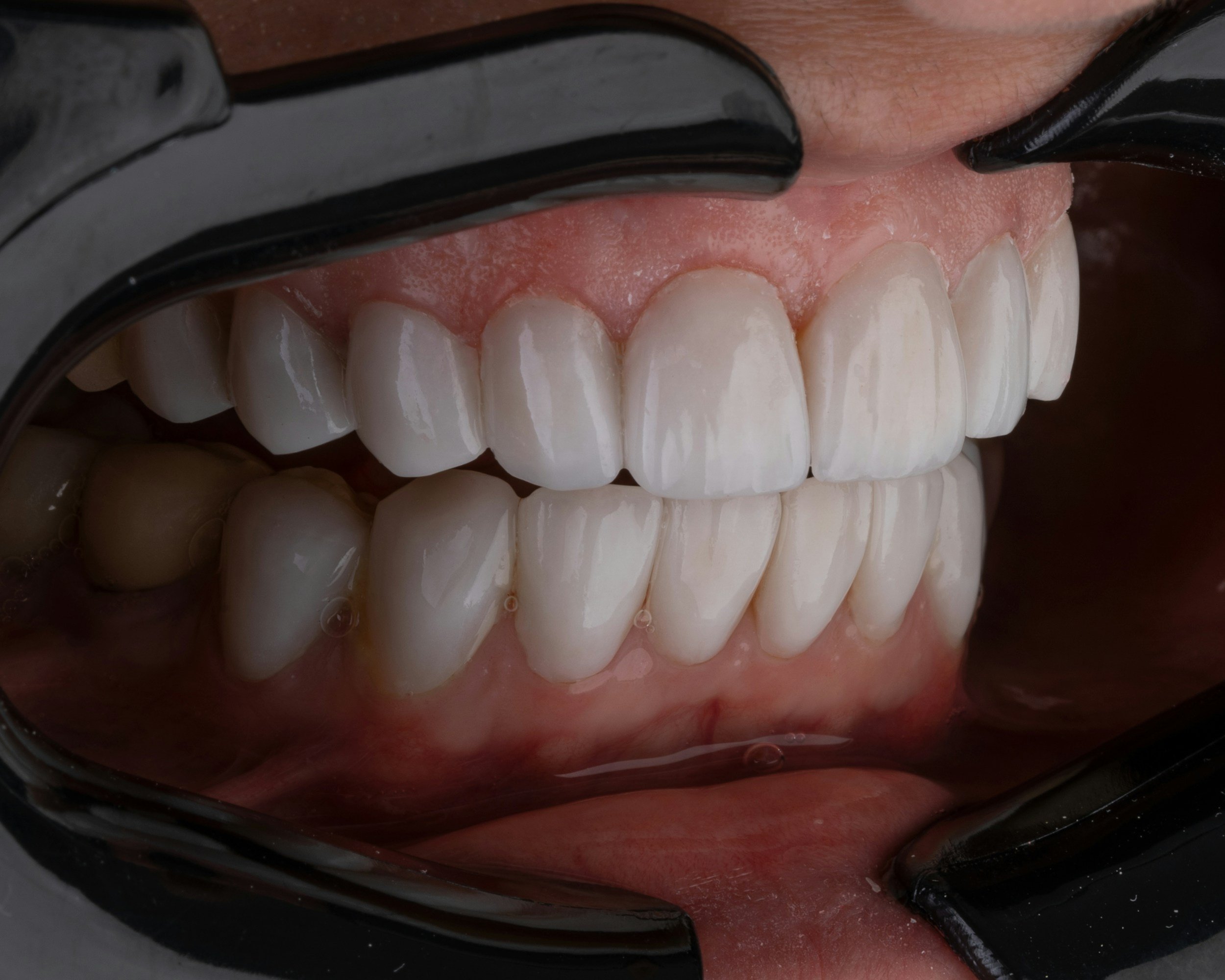 Close-up of a person's teeth and gums with a mirror reflecting the upper and lower teeth, showing healthy, white teeth and pink gums.