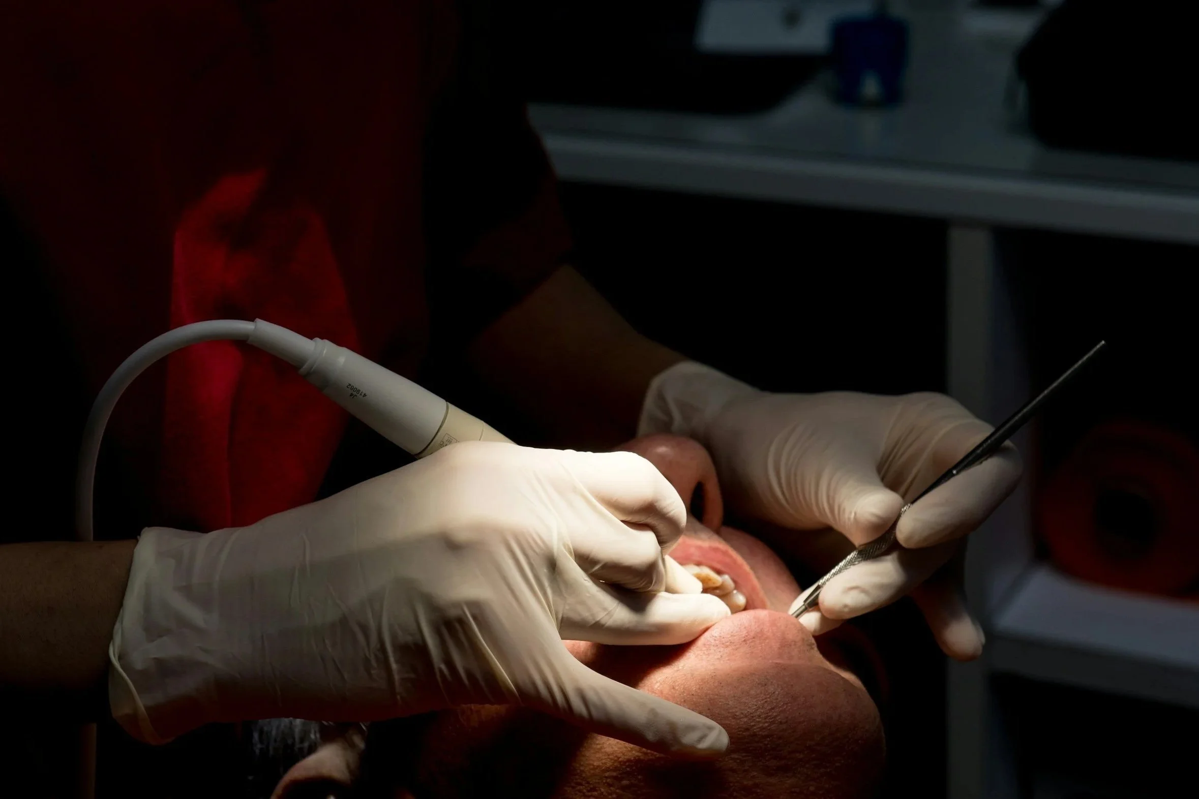Close-up of a dental procedure with hands wearing gloves using dental instruments on a patient's mouth in a dental clinic.
