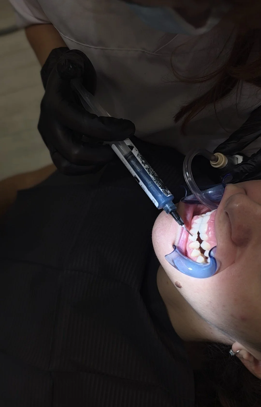 A person receiving a dental injection while lying back with a mouth retractor in place. The dentist wears black gloves and is using a syringe.