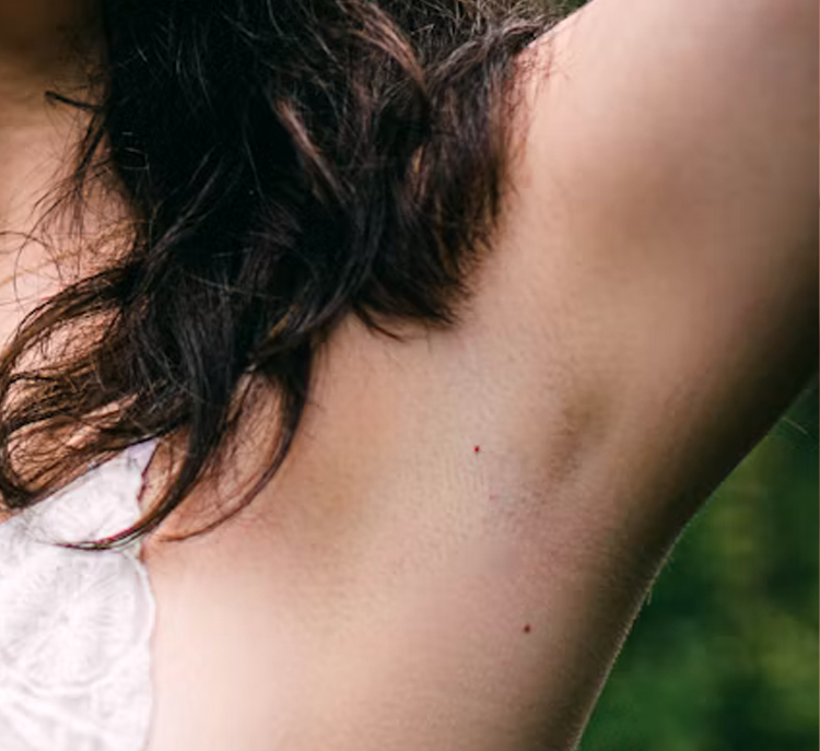 under arms toxin - hyperhidrosis