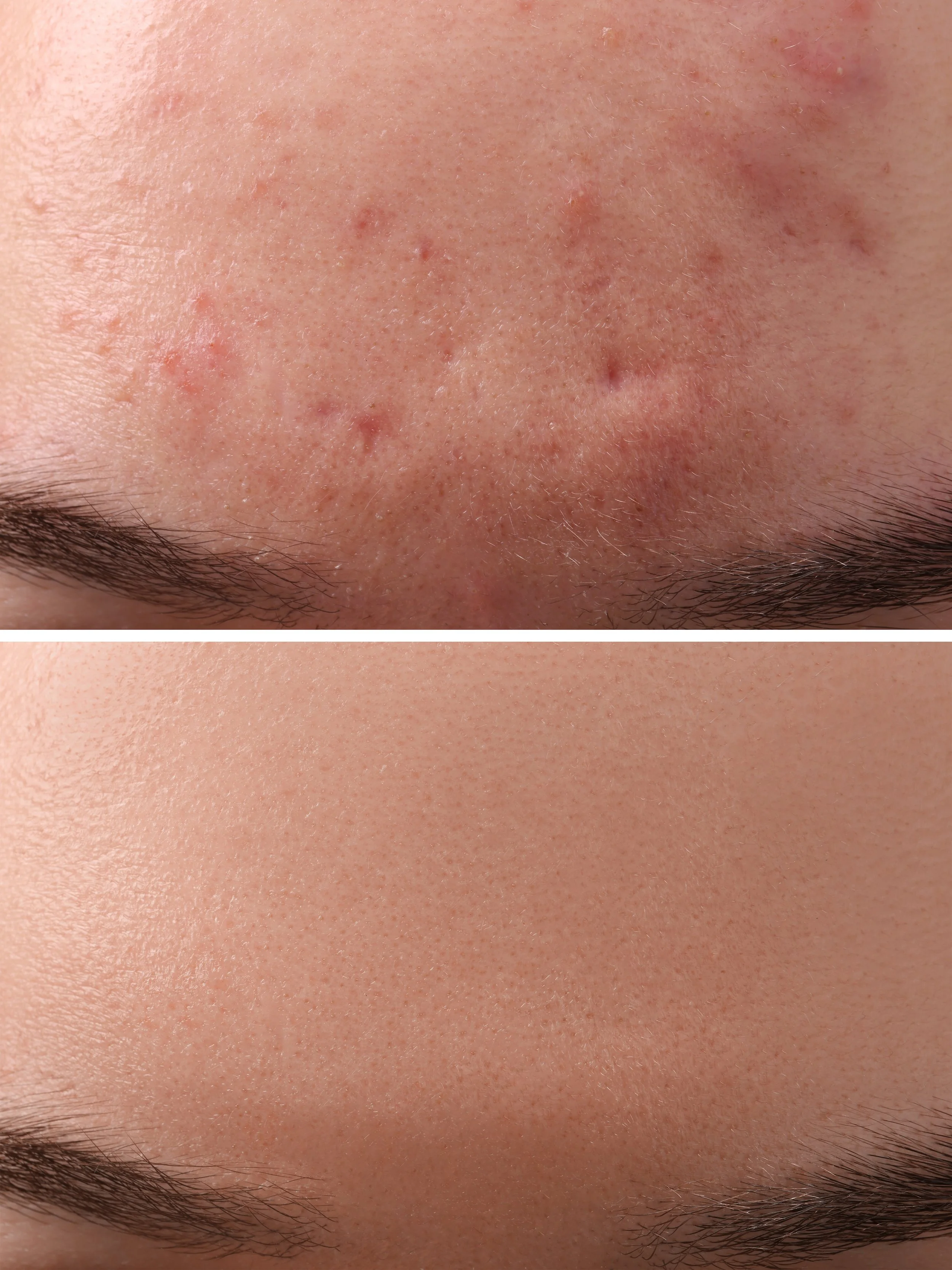 Close-up of a forehead showing before and after skin treatment, with the top image depicting acne scars and pimples, and the bottom image showing clear, smooth skin.