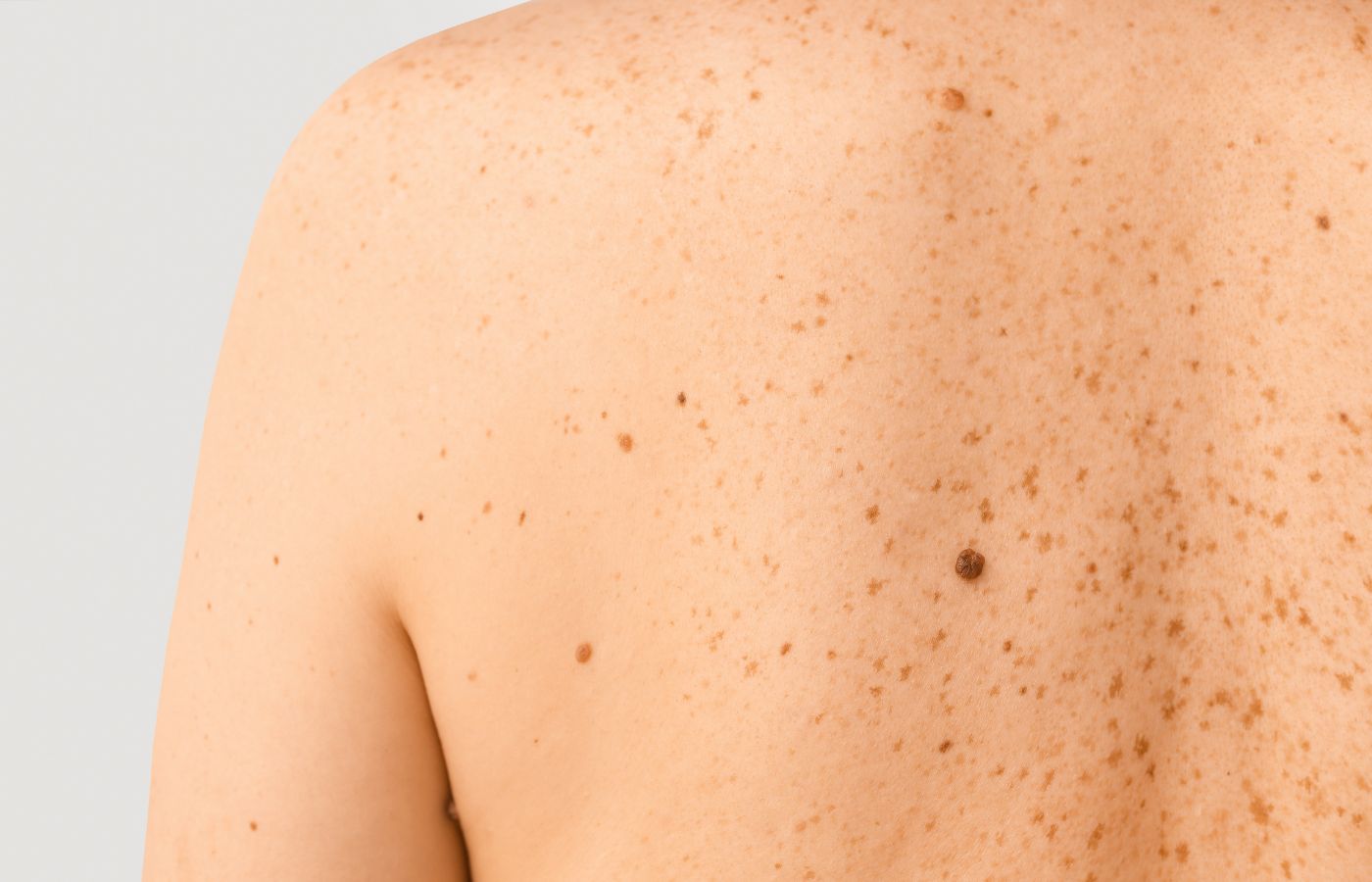 Close-up of a person's shoulder and upper chest with freckles and moles on the skin.