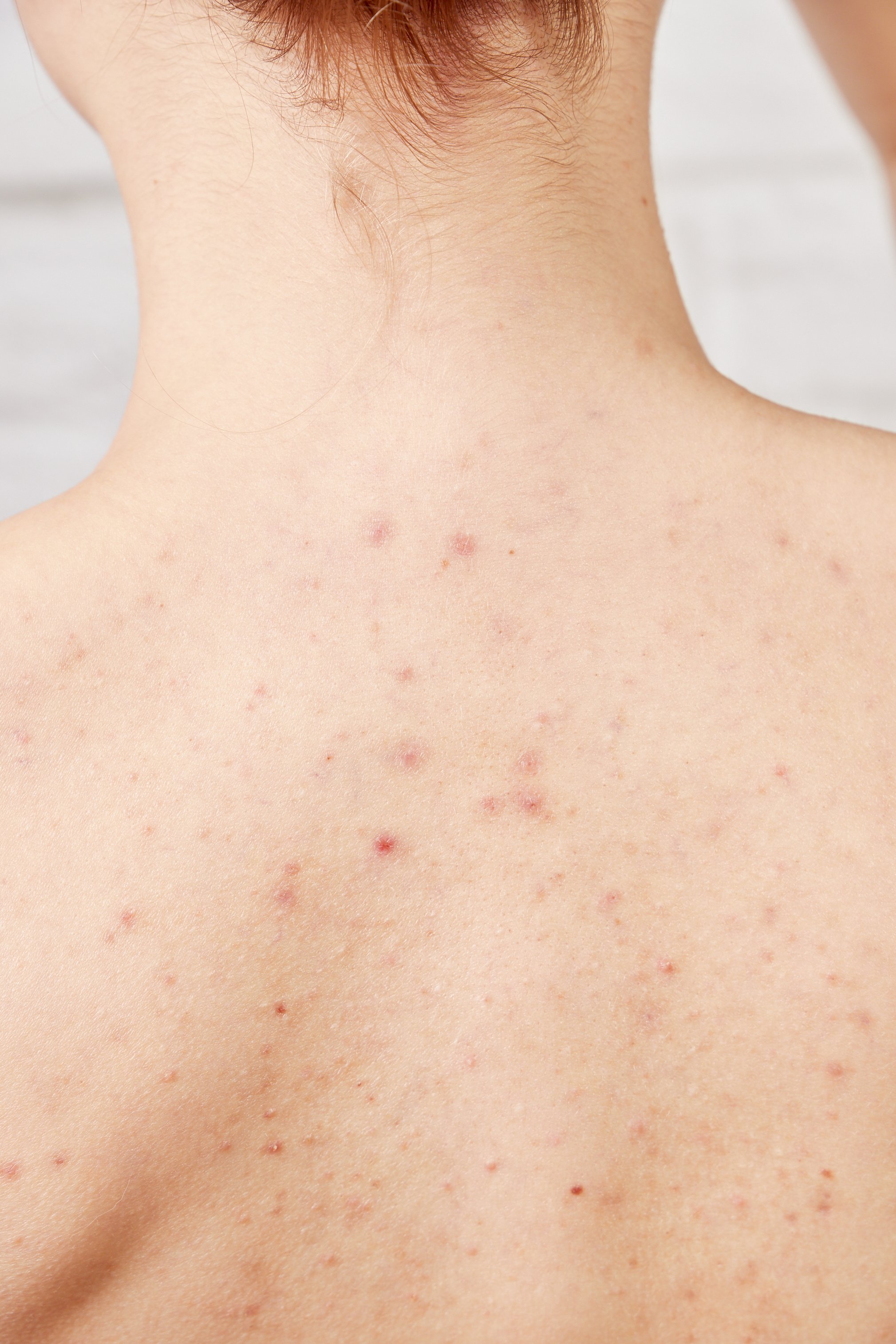 The image shows a person's back with acne and red pimples.