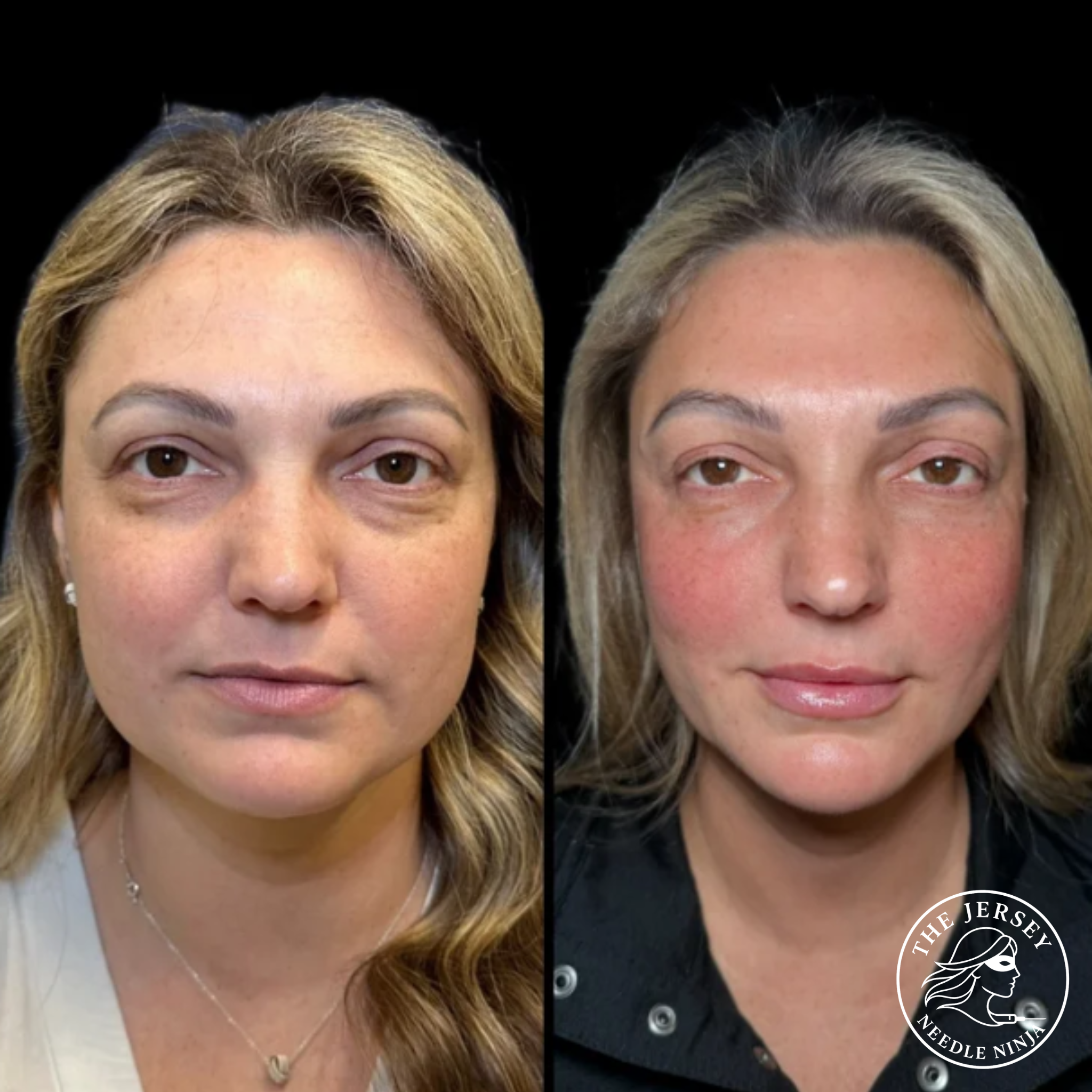 Side-by-side comparison of a woman before and after skincare treatment, showing improvements in skin clarity, redness reduction, and overall complexion.
