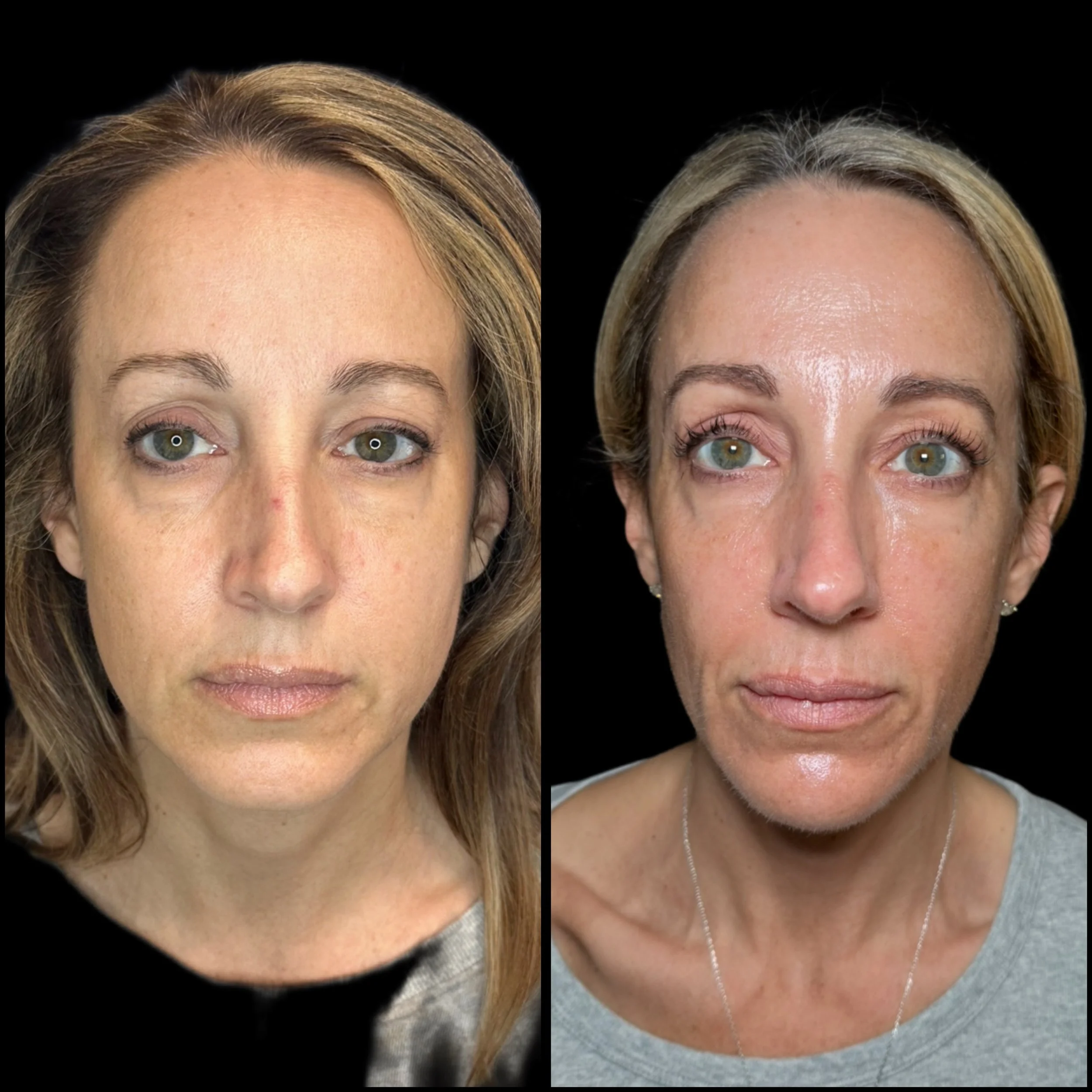 Side-by-side comparison of a woman before and after skincare or cosmetic treatment, showing improved skin texture and brightness.