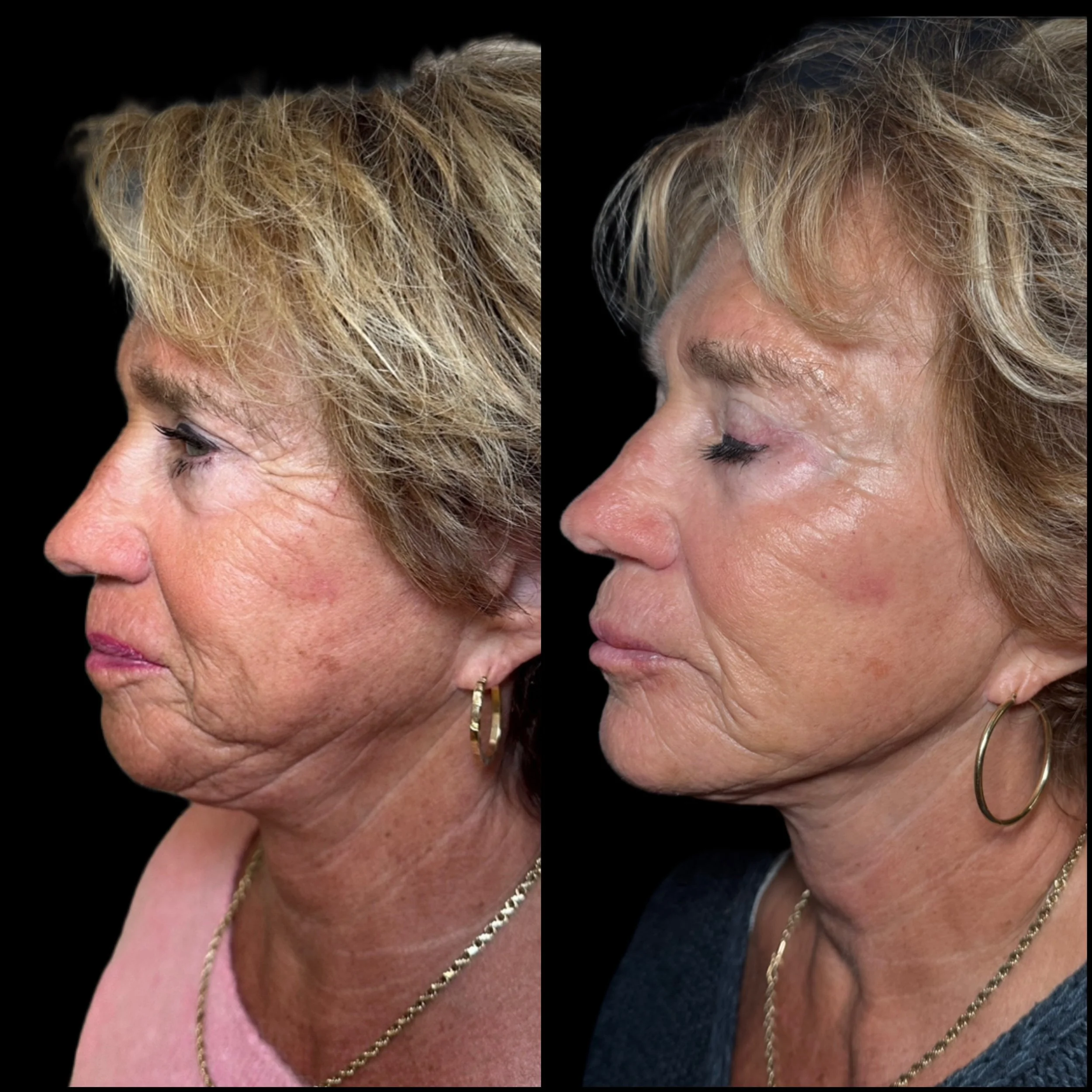 Side-by-side comparison of a woman's face before and after cosmetic treatment showing reduced wrinkles and smoother skin.