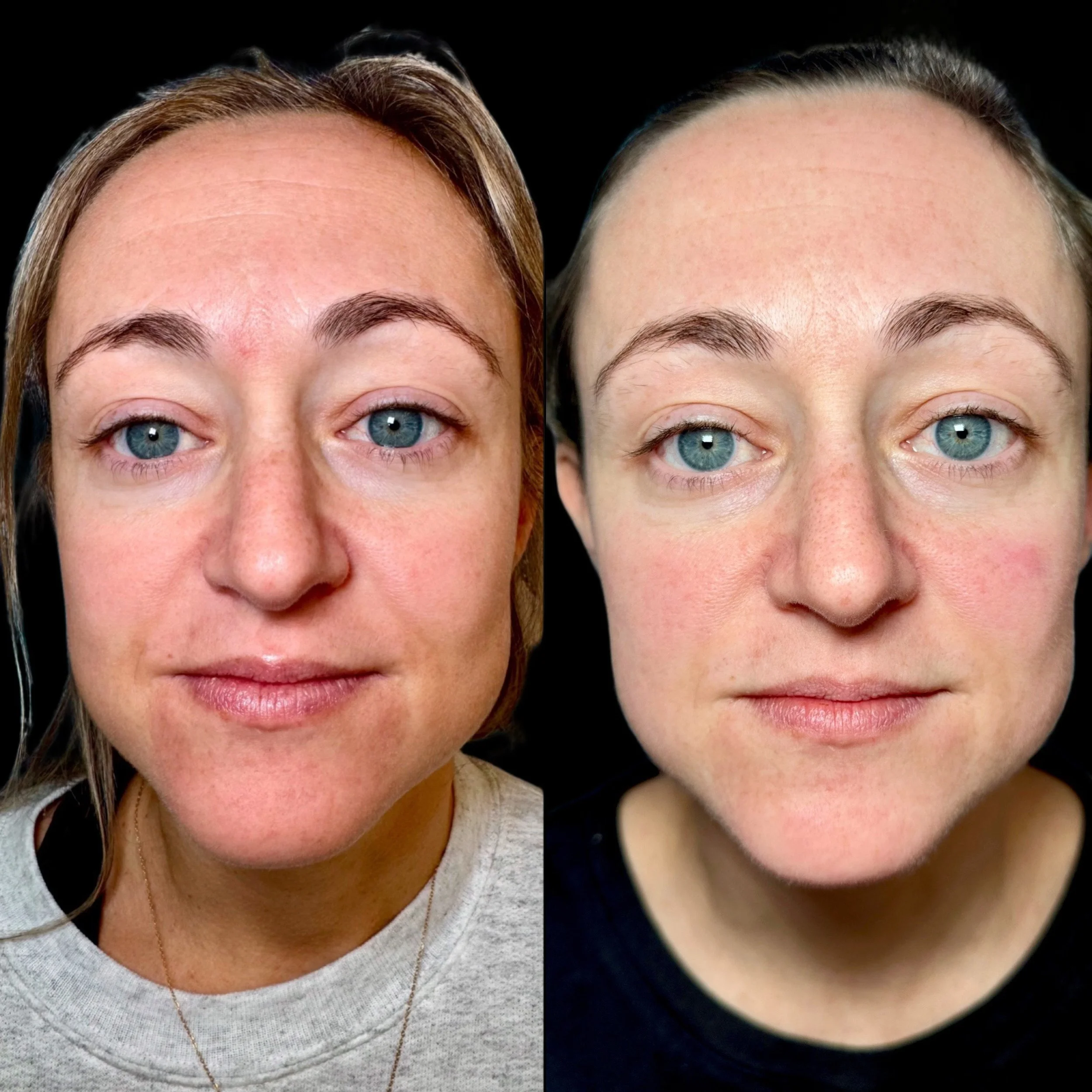 Side-by-side close-up of a woman's face before and after skincare or cosmetic treatment, with slight differences in skin appearance