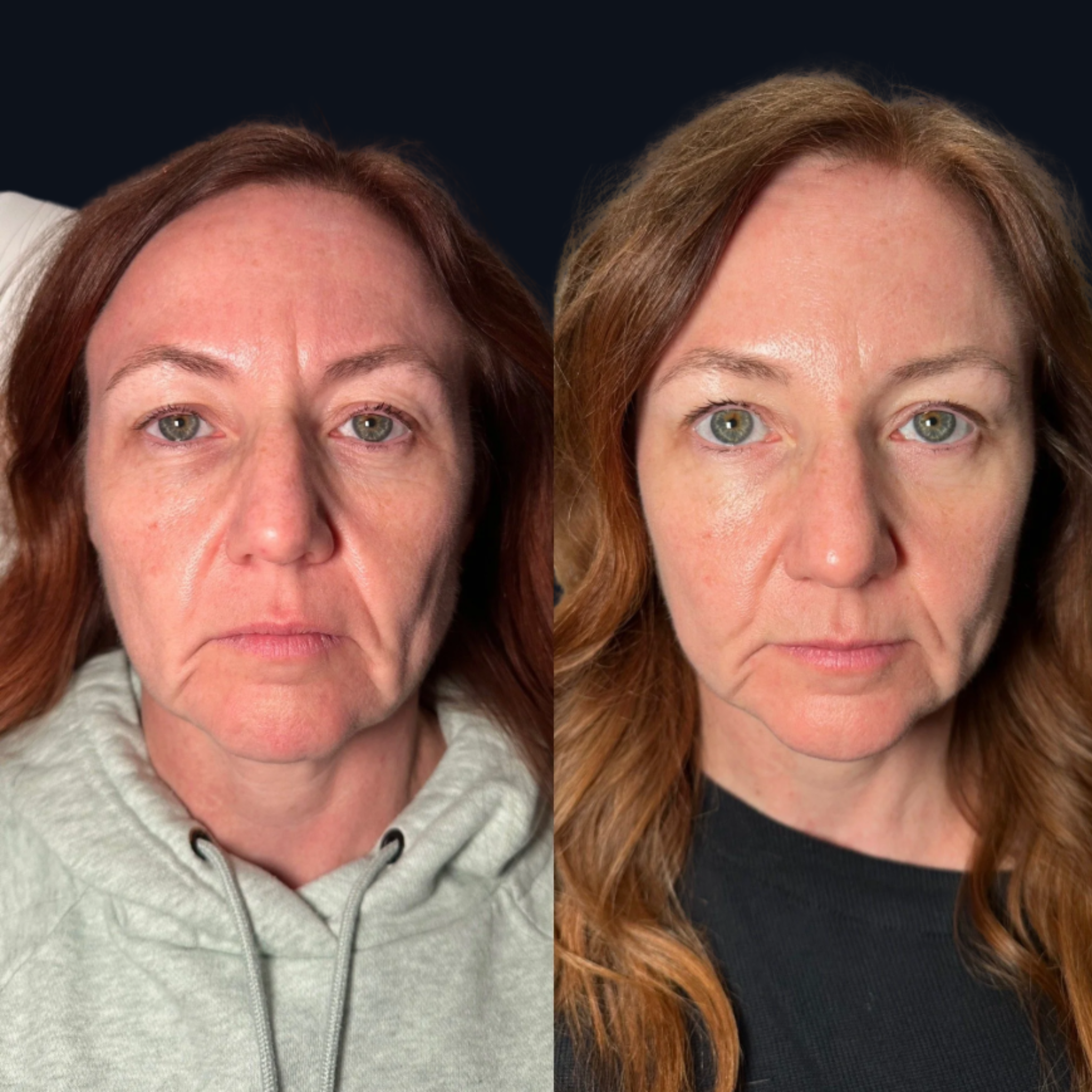 Side-by-side photos of a woman before and after cosmetic treatment, showing improved skin texture and youthful appearance.