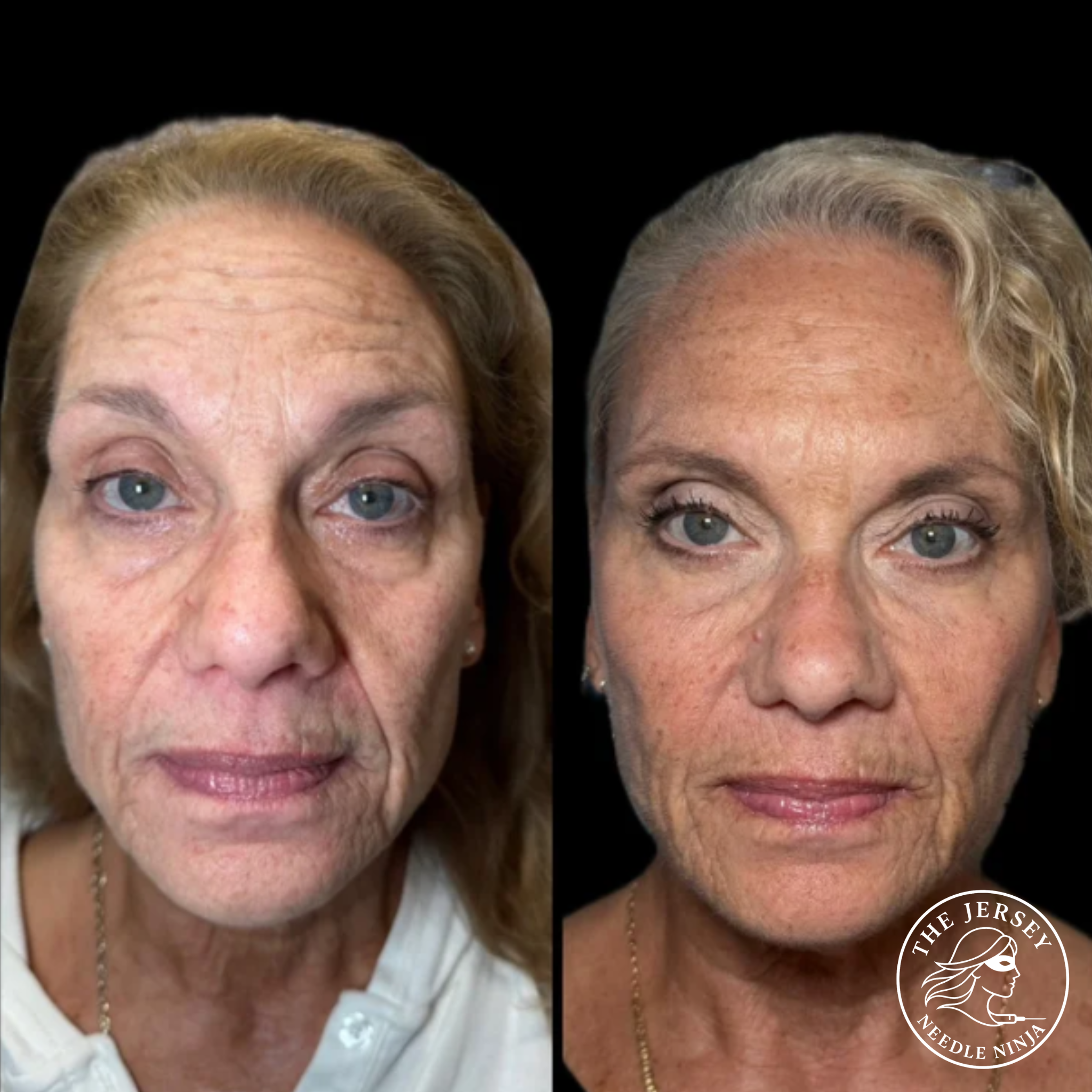 Side-by-side images of a woman's face before and after cosmetic treatment, showing improvements in skin texture, tone, and wrinkles. The before image is on the left and the after image is on the right, with a logo in the bottom right corner reading '