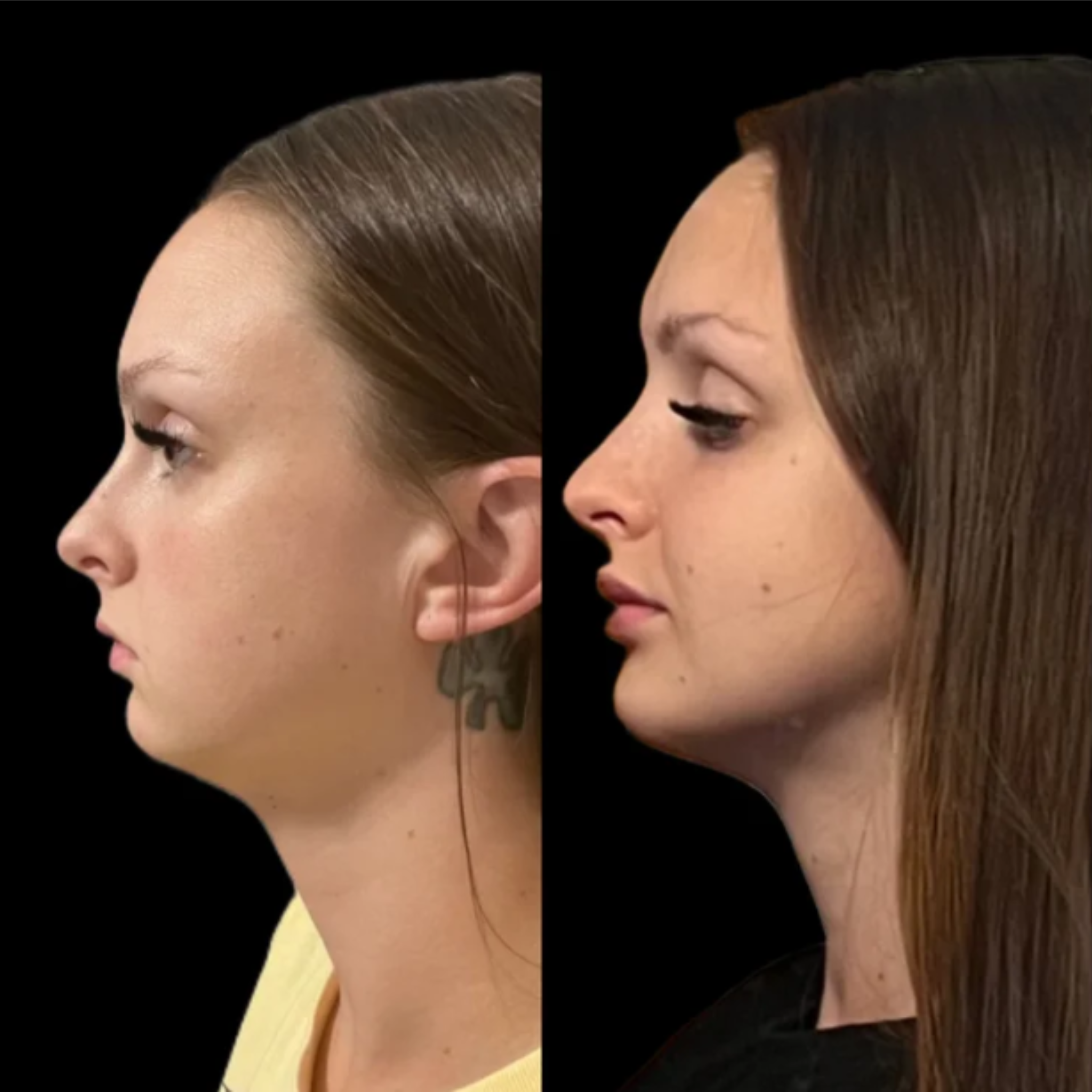 Comparison of two women's profiles with different chin and jawline shapes, both with straight brown hair, set against a black background, illustrating a before and after transformation.