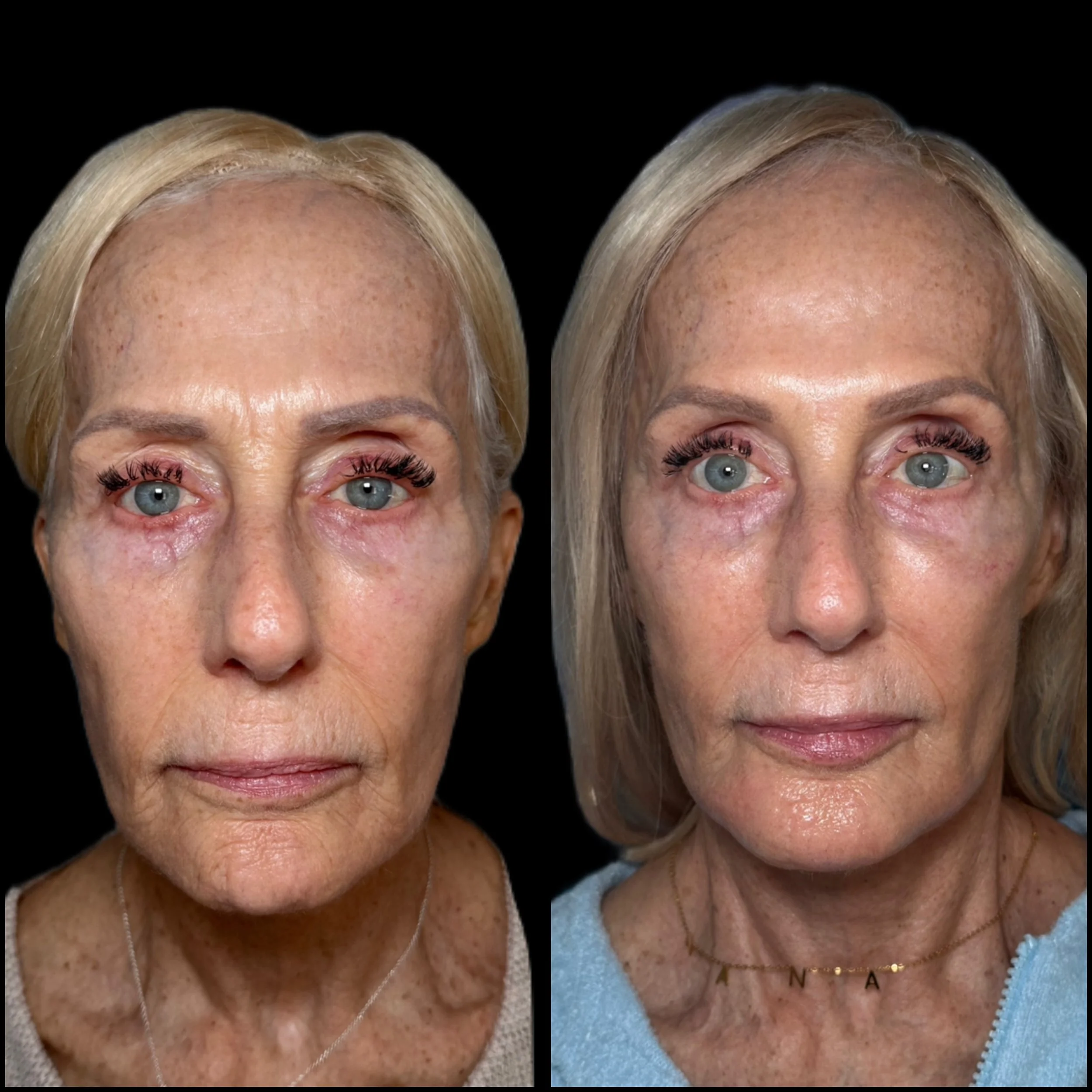 Side-by-side comparison of a woman before and after cosmetic or skincare treatment, showing improvement in skin texture and appearance.