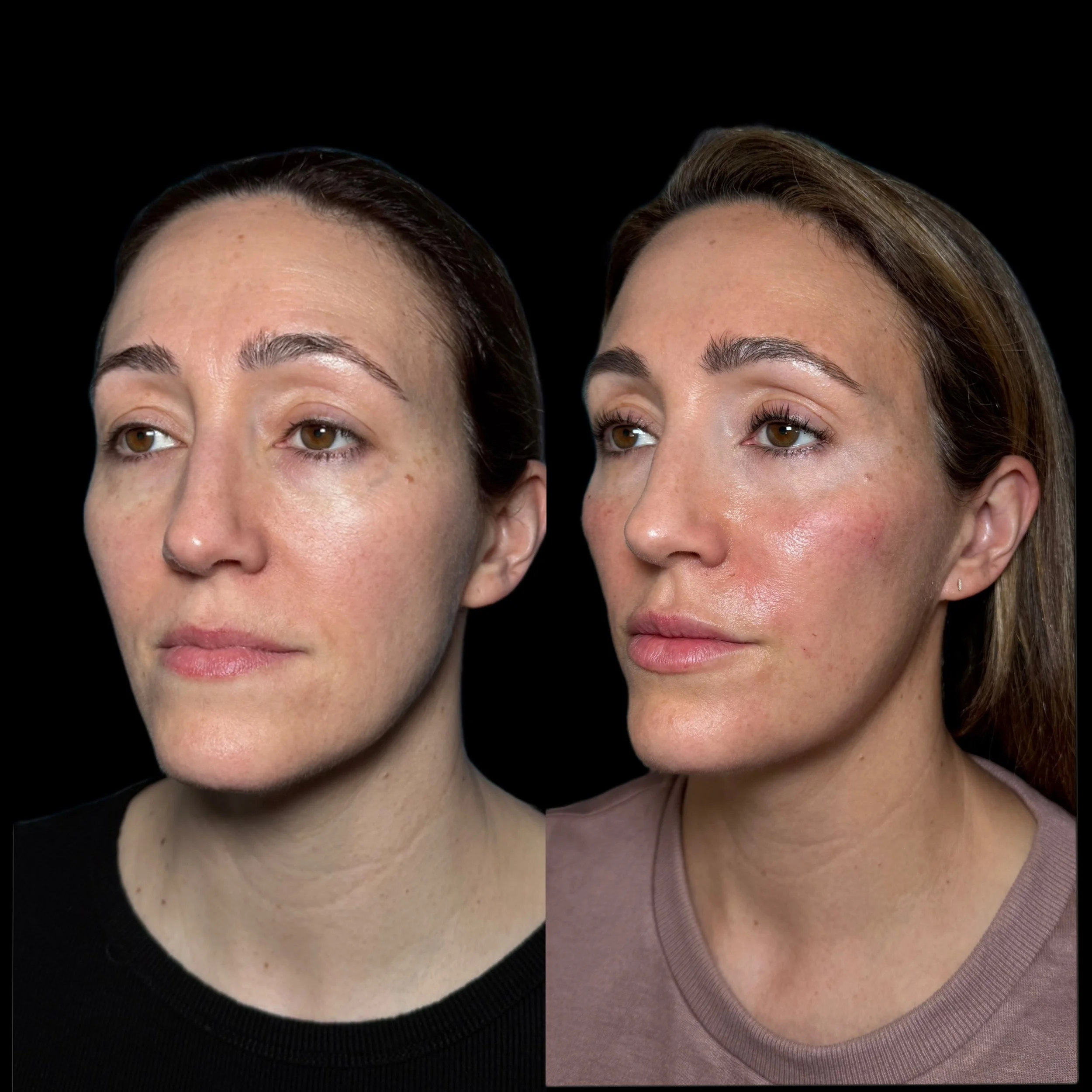 Side-by-side comparison of a woman before and after skincare treatment showing improved skin tone, reduced redness, and a more radiant complexion.